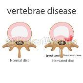 Hernia Image