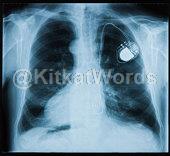 Pacemaker Image