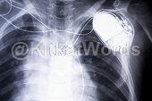 Pacemaker Image
