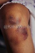 bruise Image